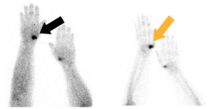 Aktivierte Arthrose sichtbar gemacht mit einer 2-Phasen Skelettszintigraphie