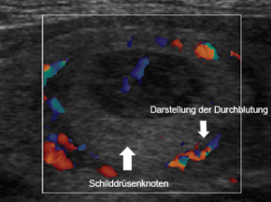 Durchblutung der Schilddrüse per Ultraschall 