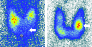 Schilddruesen Szintigraphie
