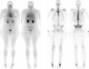 2-Phasen-Skelett-Szintigraphie
