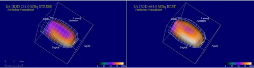 Gated SPECT 3D Darstellung